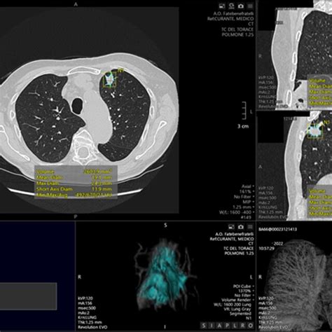 Example Of Automated Segmentation Of A Pulmonary Lesion Located In The