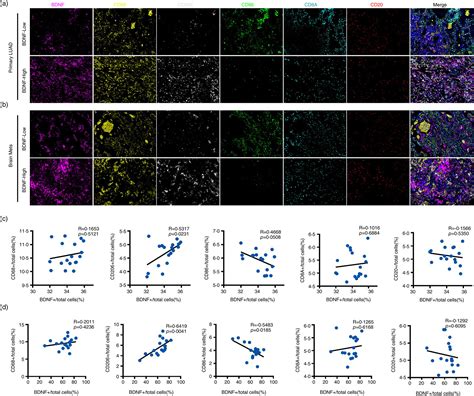 Bdnf Is A Prognostic Biomarker Involved In Immune Infiltration Of Lung