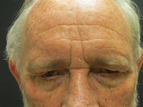 Eyelid Malpositions Ptosis Alicia Carroll Md Oprsc