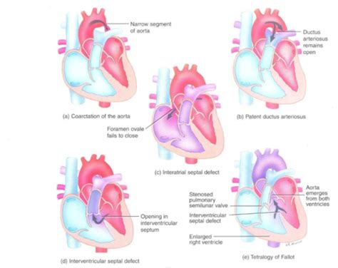 Patho Exam Cardio Flashcards Quizlet