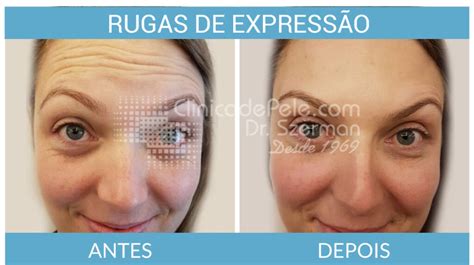 Botox Dura Quanto Tempo Veja Fatores Clinica De Pele