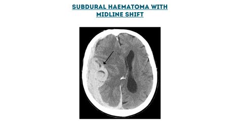 CT Head Interpretation | Radiology | Geeky Medics