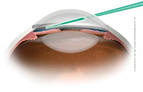 Selective Laser Trabeculoplasty at Grin Eye Care