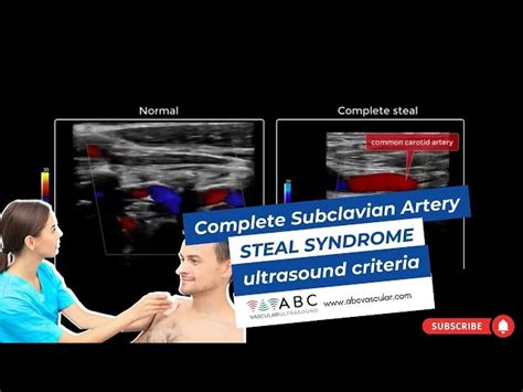 Causes Subclavian Steal Syndrome