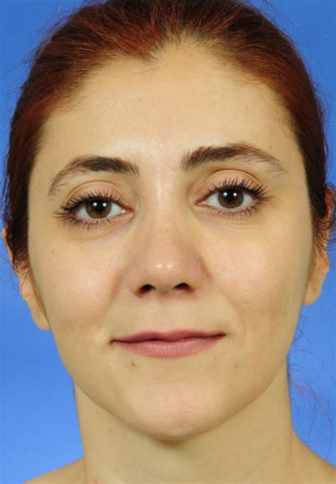 Rhinoplasty Nose Job Otoplasty Prof Dr Selçuk İnanlı