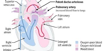 Patent Ductus Arteriosis Usmle Rx