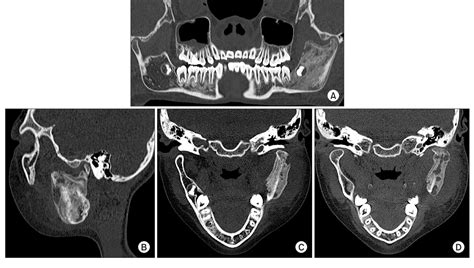 Figure 3 From Proliferative Periostitis Of The Mandibular Ramus And Condyle A Case Report