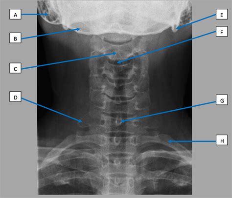 Diagram of Cervical Spine x ray | Quizlet