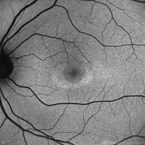 Plaquenil Toxicity Retina Image Bank