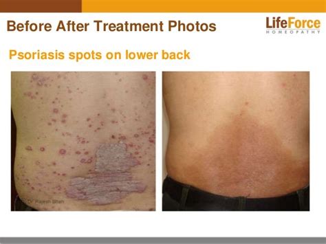 Psoriasis on Back Photos: Before After Treatment Pictures of Patients…