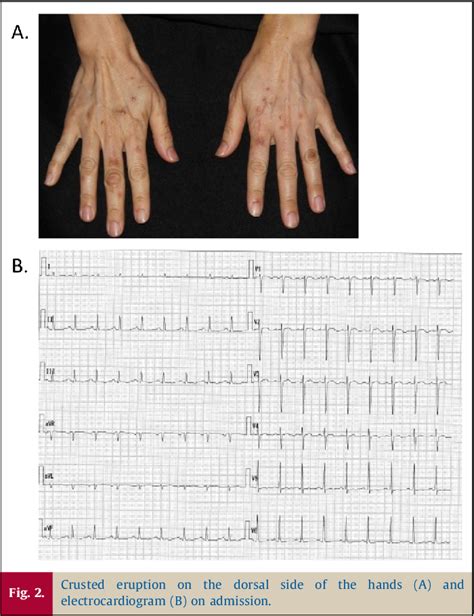 Figure 1 From A Rare Case Of Eosinophilic Granulomatosis With