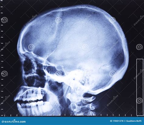 头骨x 射线 库存照片 图片 包括有 造影 头骨 诊断 健康 图象 临床 诊所 检查 光芒 19001378