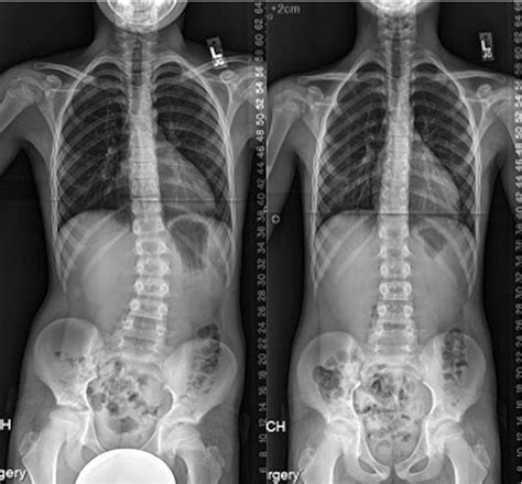 Figure 4 From Leg Length Discrepancy Functional Scoliosis And Low