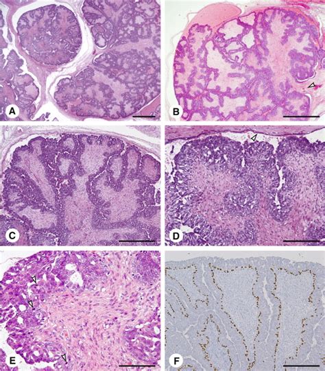 Histology Of The Tumor A And B Low Power View Of The Tumor