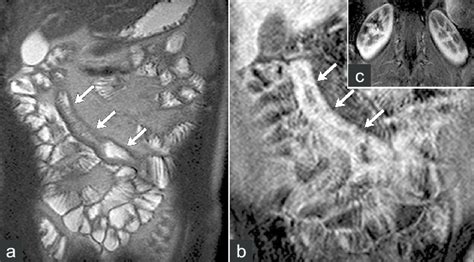 A Coronal T Weighted And B Post Contrast T Weighted Images Of The