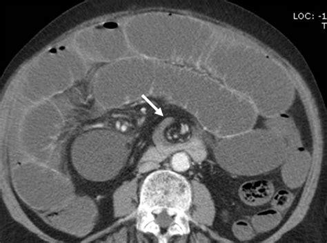 Small Bowel Obstruction What To Look For Radiographics