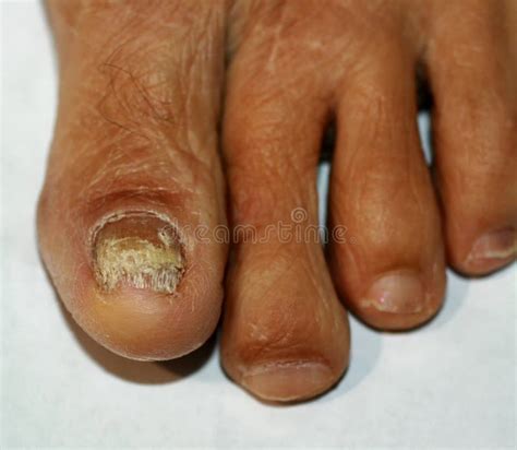 Fungal Nail Infection On Big Toe Stock Image Image Of Fungus Disease