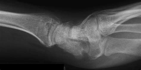 Reconstruction Revision Scaphoid Nonunion With Hardware Removal Bone