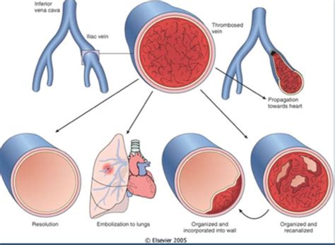 Pathology Hemodynamic Disorders Part 2 Flashcards Quizlet