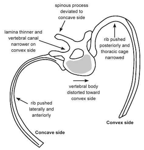 Concave Vs Convex Scoliosis