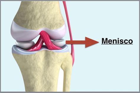 Lesão no Menisco Sintomas e Tratamento Tua Saúde
