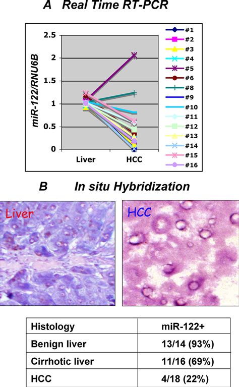 Expression Of Mir 122 Is Reduced In Primary Hccs A Expression Of