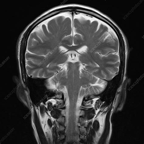 Healthy brain, MRI scan - Stock Image - F039/4338 - Science Photo Library