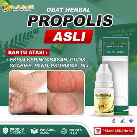 Jual Obat Salep Gatal Kulit Eksim Kering Dan Basah Menahun Gatel