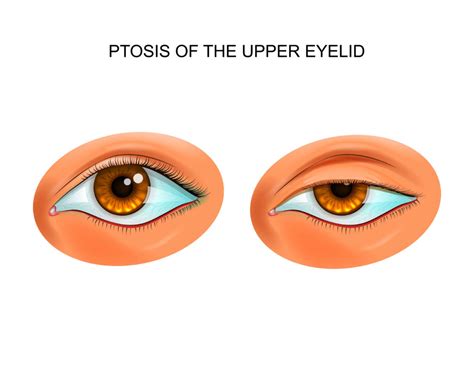 Ptosis Types Causes Symptoms Diagnosis Treatment And More Healthroid