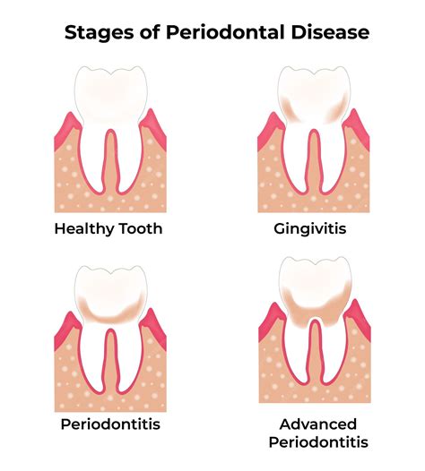 Premium Vector Stages Of Periodontal Disease Healthy Tooth Gingivitis