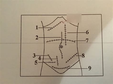 Abdominal Incisions Diagram Quizlet