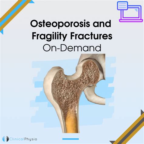 Osteoporosis And Fragility Fractures On Demand Webinar Clinical Physio