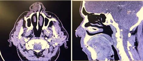 Schwannoma Of The Lateral Nasal Wall A Case Report Barati 2022