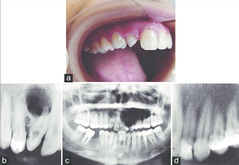 A Preoperative Photograph Peg Shape Right Maxillary Lateral Incisor