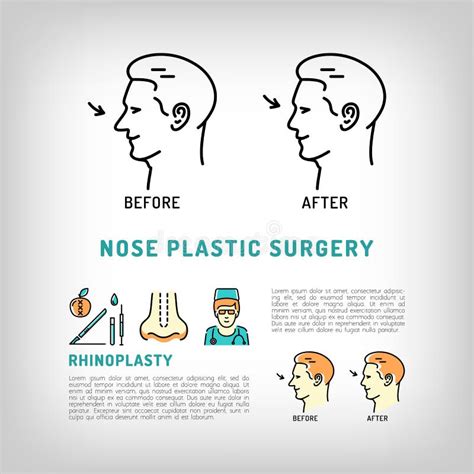 Rhinoplasty Nose Plastic Surgery Logos Vector Art Line Icons Set Stock Vector Illustration Of