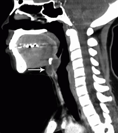 Soft Tissue Neck Radiology Key