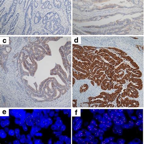 HER2 Evaluation By Immunohistochemistry And Fluorescence In Situ