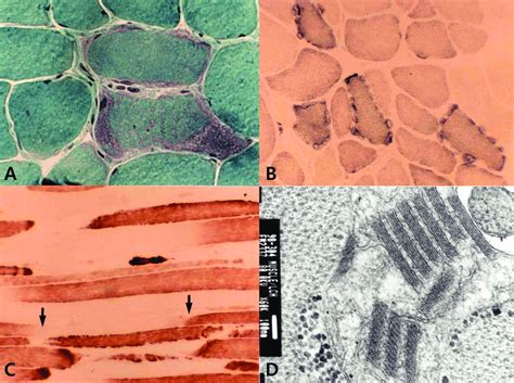 Histochemical And Electron Microscopic Findings Of Mitochondrial