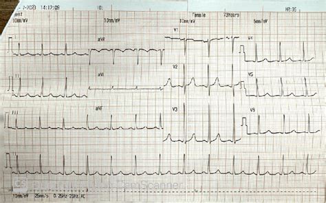 Electrocardiography Showed Sinus Rhythm Bpm Left Ventricular