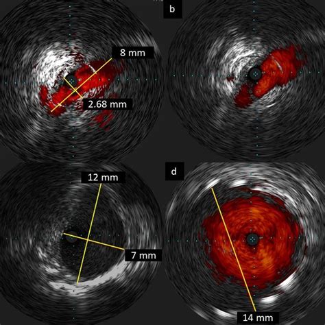 Selective Angiography Of The Right Pulmonary Artery Presents A Subtotal