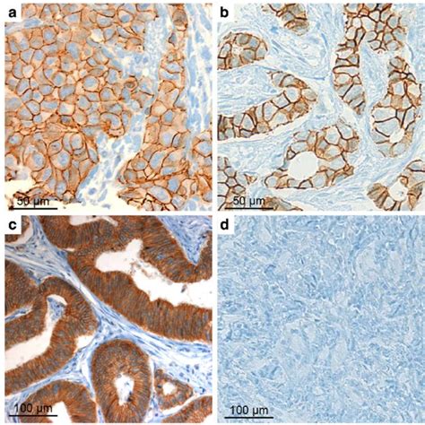 E Cadherin Positive Staining In BRCA1 Mutated A And BRCA Wild Type