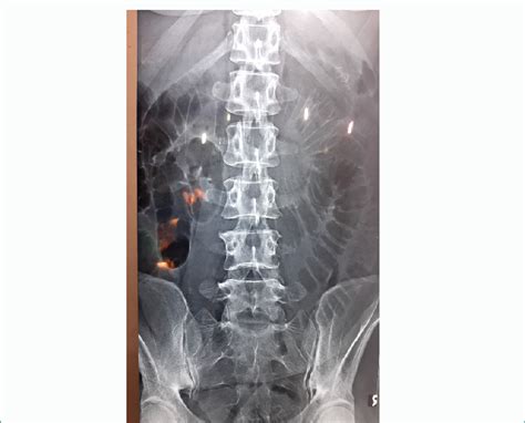 Supine Abdominal X Ray Download Scientific Diagram