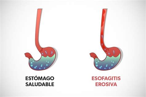 Esofagitis erosiva qué es clasificación de Los Ángeles y tratamiento