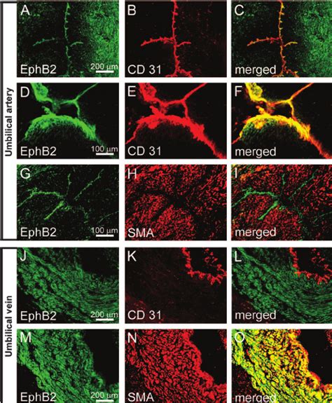 Ephrinb2 Ephb2 And Ephb4 Expression In Venous Malformations Download Scientific Diagram