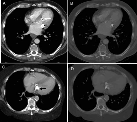 Cardiac Findings On Non Gated Chest Computed Tomography A Clinical And