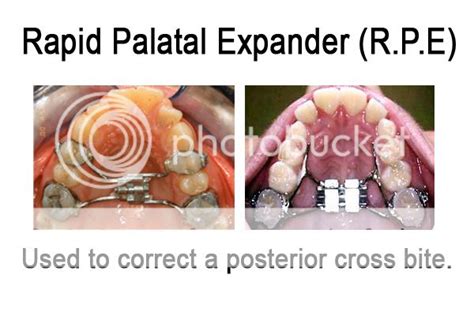 Rapid Palatal Expander (RPE)