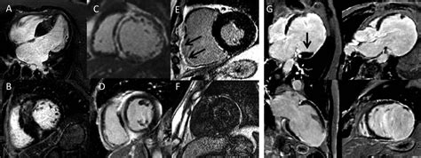 Cardiovascular Magnetic Resonance Imaging What The General