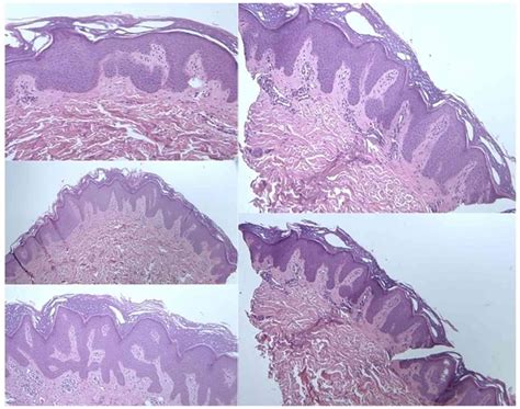 Psoriasis Induced By Firstline Pembrolizumab In Metastatic Nonsmall