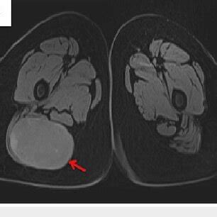 Pre Operative Pelvic Mri A T Weighted Image The Lesion Is Isointense