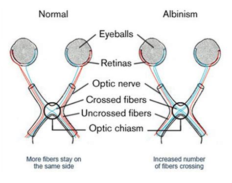 Albinism Definition, Symptoms & Side Effects | Study.com